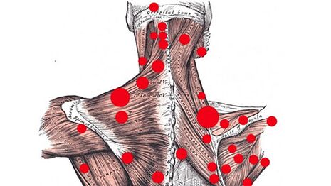 Trigger points in muscles that cause myofascial pain in the back
