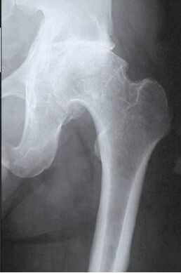 Magnetic resonance scan of the affected hip joint