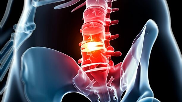 lumbar spine osteochondrosis