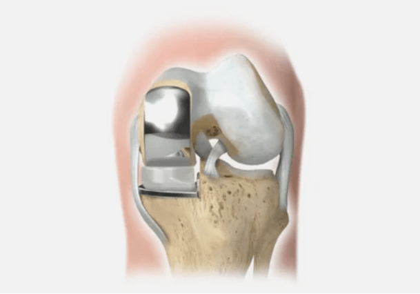 a part of the joint is damaged
